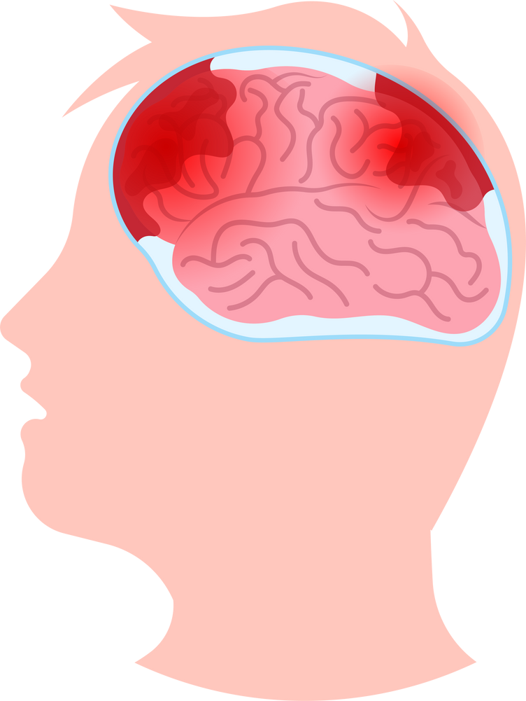 concussion traumatic bleeding whiplash head migraine headache subdural hematoma amnesia confusion vertigo accident collision neurology pain disease disorder hemorrhage aneurysm brain injury bleed post syndrome sport concussive memory loss skull painful